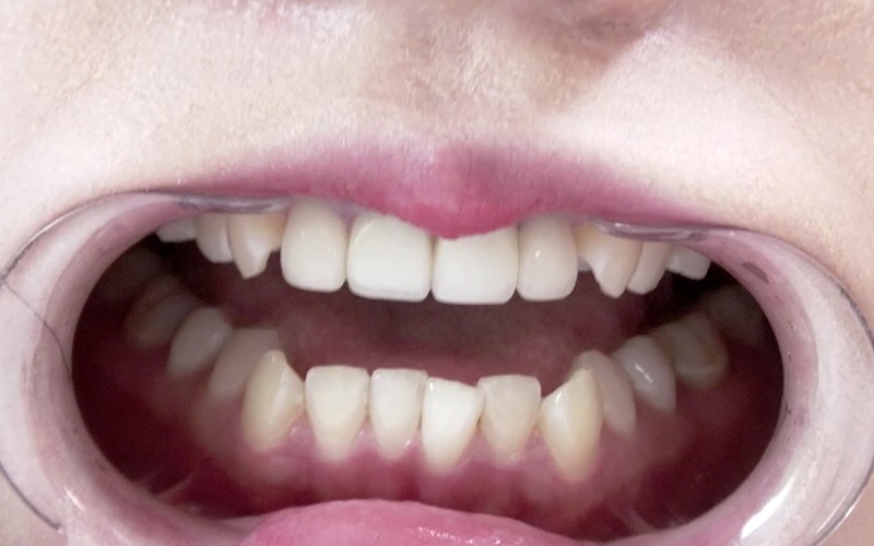 AD-338 Part 11 - 30 minutes