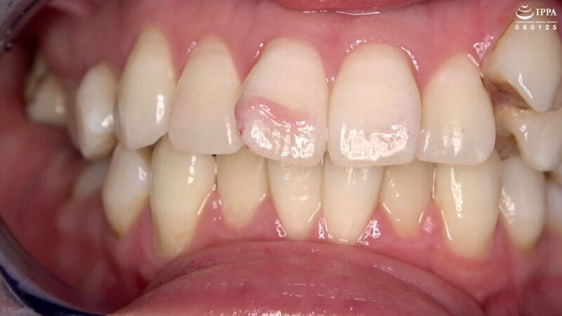 AD-956 第 10 部分 - 30 分钟