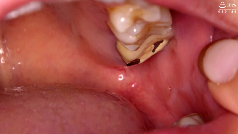 【歯・口内フェチ】綺麗なお姉さんの激レアな治療跡がある歯・口内・のどちんこ観察！ 美泉咲 18