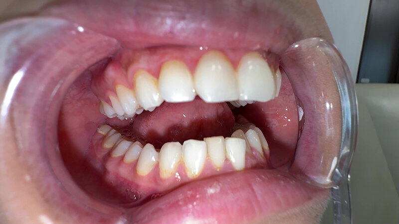 Y-311 Bagian 17 - 30 minit