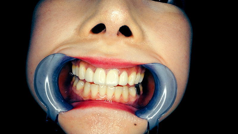 YA-01103 パート 13 - 30 分